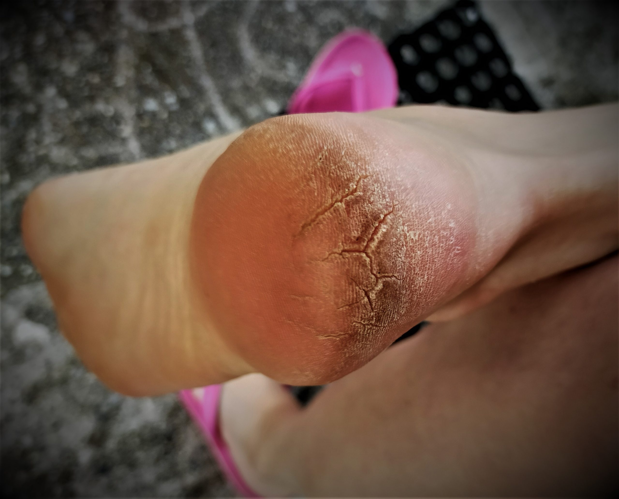 Kloven 6 tips wat u er zelf aan kan doen Medisch Pedicure Maria